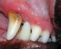Mild tartar and gingivitis